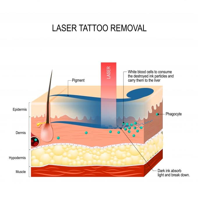 How Does Laser Tattoo Removal Work? | Baird,MD