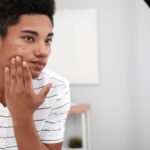 cystic acne