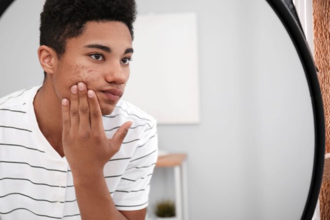 cystic acne